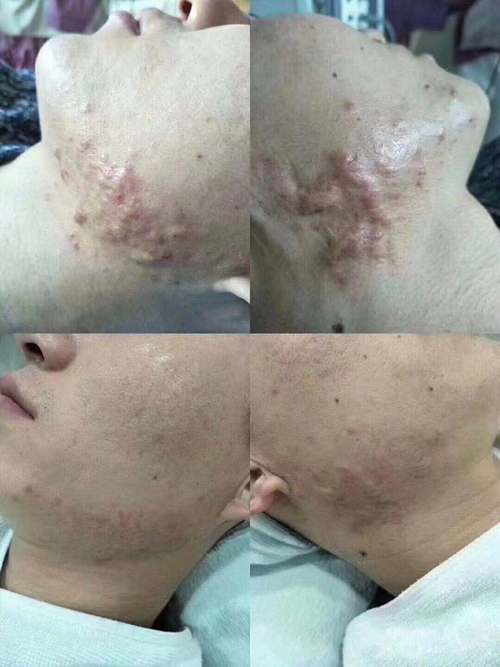 针清祛痘会留痘坑吗？-图3