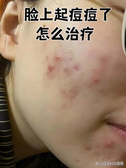 祛痘挤痘是美容院好选择吗?-图1 祛痘挤痘是美容院好选择吗?-图1
