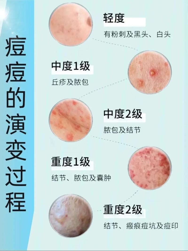 祛痘挤痘是美容院好选择吗?-图2 祛痘挤痘是美容院好选择吗?-图2