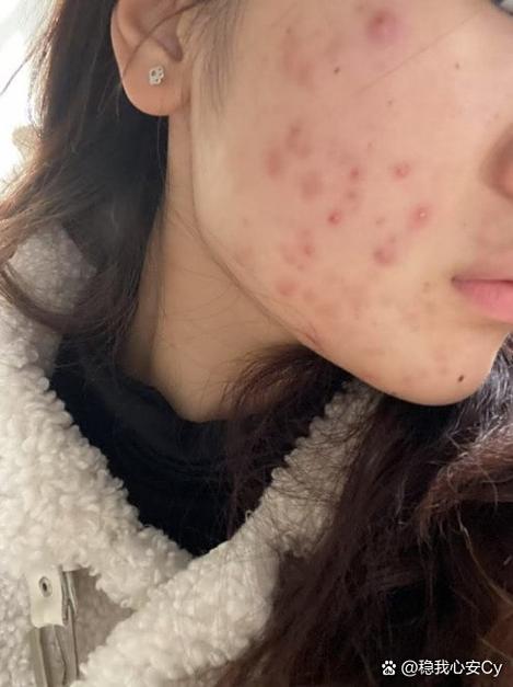 清痘洗面奶真能祛痘吗?-图2 清痘洗面奶真能祛痘吗?-图2