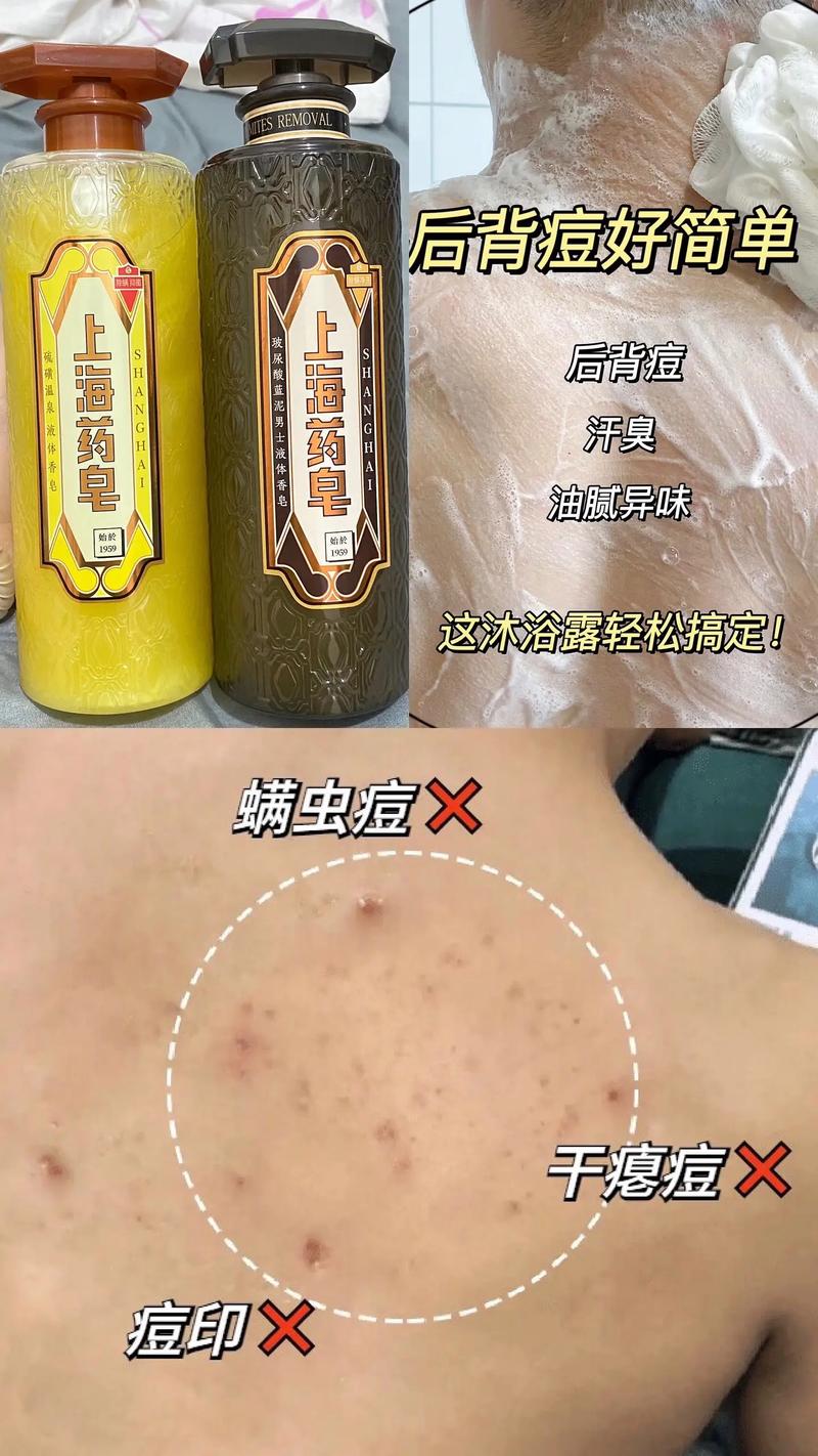 硫磺皂祛痘祛螨有用吗-图3 硫磺皂祛痘祛螨有用吗-图3