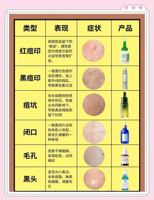 激光祛痘去痘印效果如何？-图2