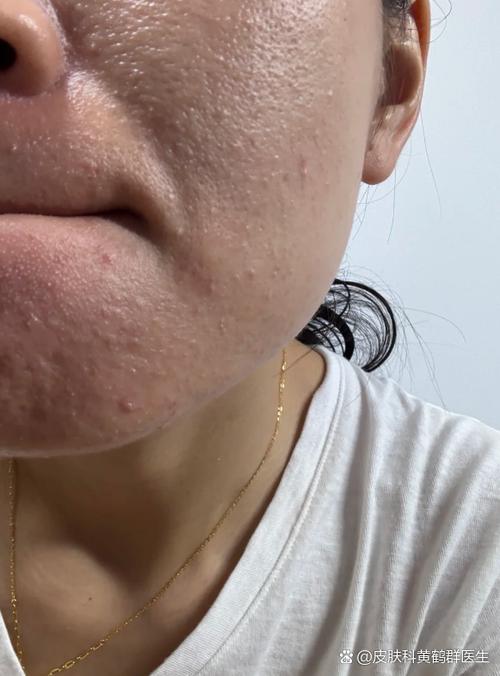 护肤品用后起小米粒疙瘩是过敏吗？-图1