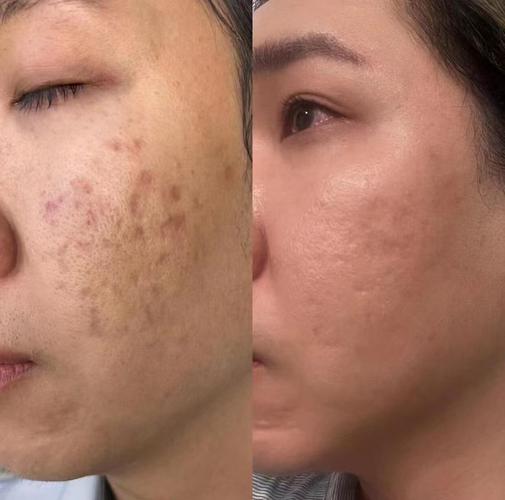 痘印修复和祛痘,到底有啥区别?-图2 痘印修复和祛痘,到底有啥区别?-图2