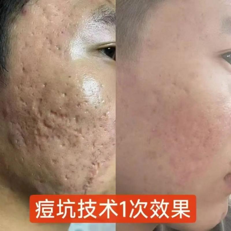 痘印修复和祛痘,到底有啥区别?-图1 痘印修复和祛痘,到底有啥区别?-图1