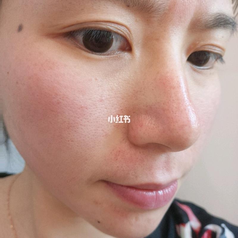 理肤泉祛痘能同时改善毛孔粗大吗？-图2