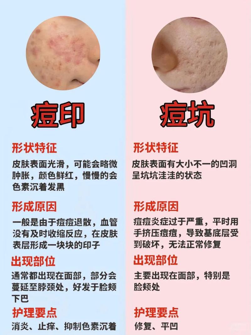 男生如何快速祛痘痕痘印?-图1 男生如何快速祛痘痕痘印?-图1