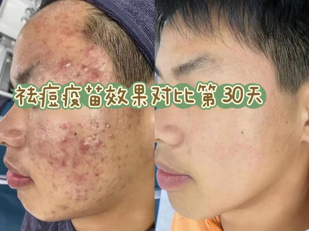 男生如何快速祛痘痕痘印?-图2 男生如何快速祛痘痕痘印?-图2