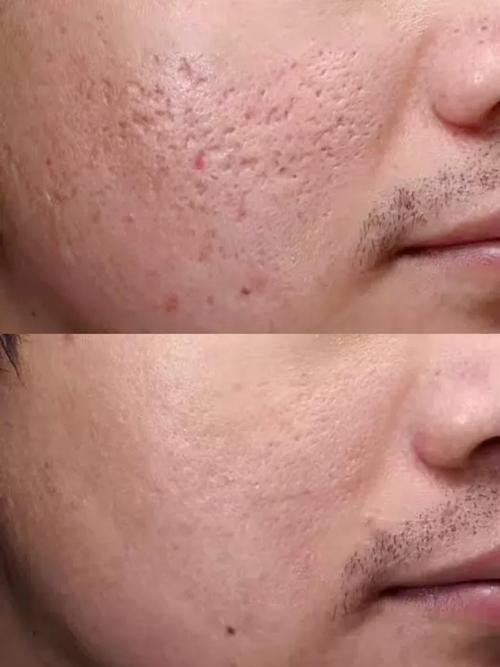 祛痘坑痘印,生活细节怎么改善?-图1 祛痘坑痘印,生活细节怎么改善?-图1