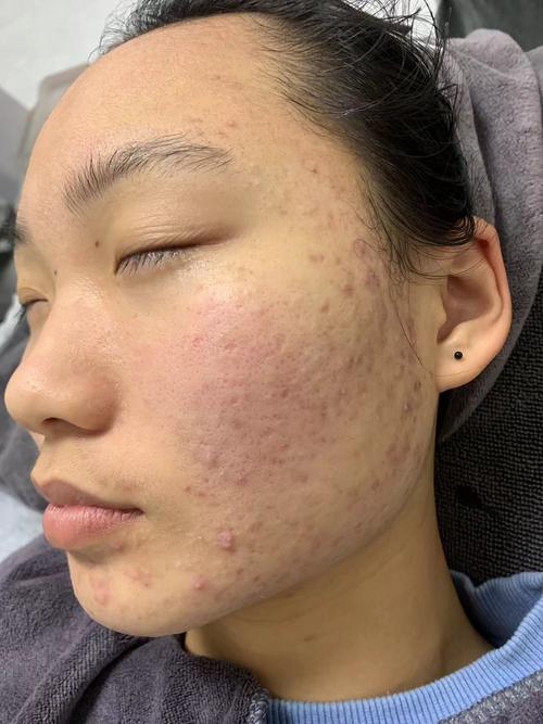 祛痘坑痘印,生活细节怎么改善?-图2 祛痘坑痘印,生活细节怎么改善?-图2