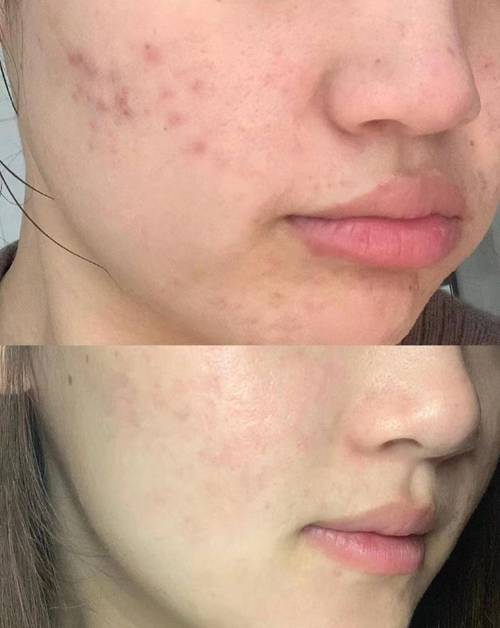 祛痘坑痘印,生活细节怎么改善?-图3 祛痘坑痘印,生活细节怎么改善?-图3