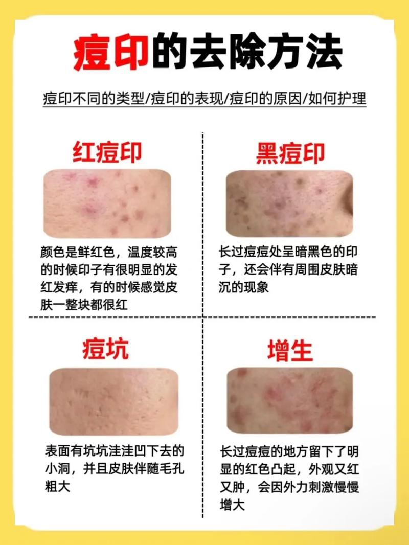 祛痘祛痘印,哪种方法最有效?-图1 祛痘祛痘印,哪种方法最有效?-图1