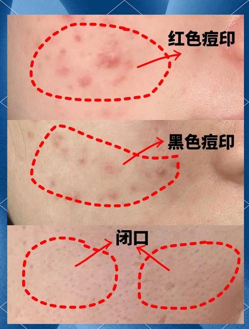 祛痘祛痘印，哪种方法最有效？-图2