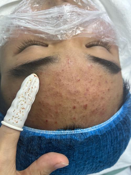 acne.org祛痘效果到底怎么样?-图2 acne.org祛痘效果到底怎么样?-图2