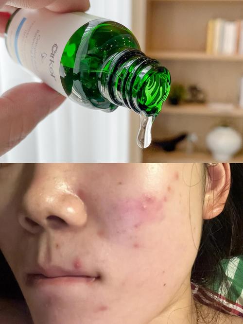 Cici小黑瓶 祛痘-图1