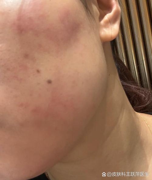 护肤品上脸刺痛是过敏了吗？-图2