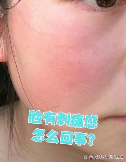护肤品上脸刺痛是过敏了吗？-图3