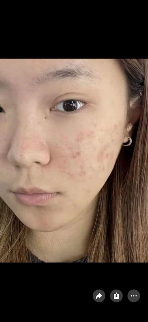 祛痘印产品用后反起痘,为何会这样?-图1 祛痘印产品用后反起痘,为何会这样?-图1