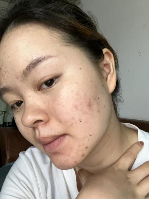 祛痘印产品用后反起痘,为何会这样?-图2 祛痘印产品用后反起痘,为何会这样?-图2