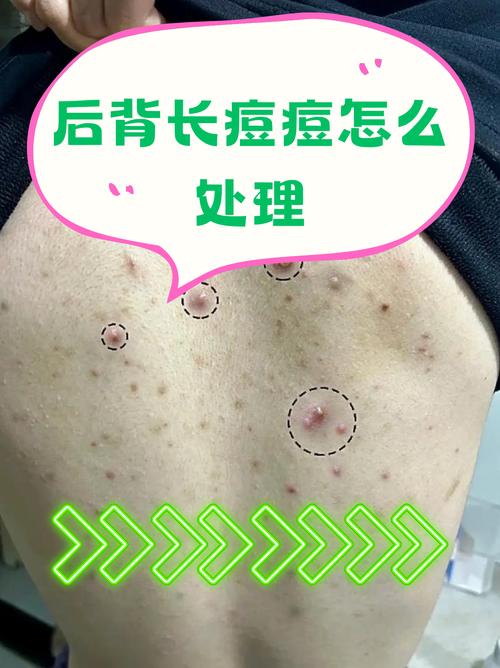 Lush脸部背部祛痘效果如何？-图1