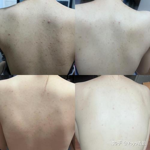 Lush脸部背部祛痘效果如何？-图2