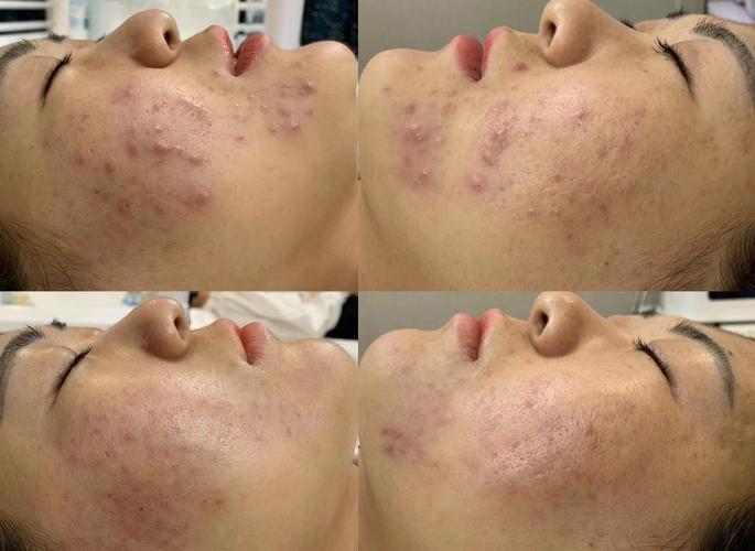 Lush脸部背部祛痘效果如何？-图3