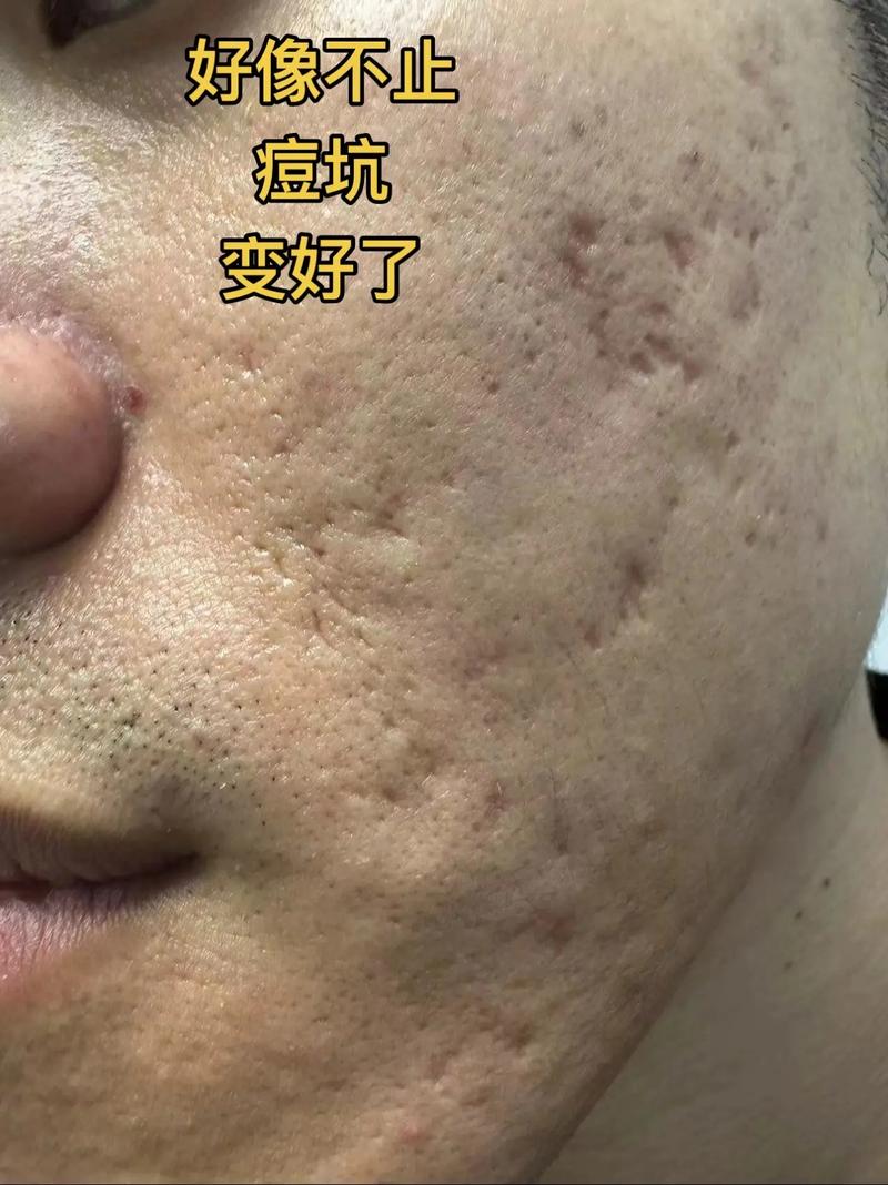 瓷肌祛痘后为何还长痘?-图1 瓷肌祛痘后为何还长痘?-图1