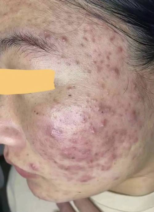 瓷肌祛痘后为何还长痘?-图2 瓷肌祛痘后为何还长痘?-图2