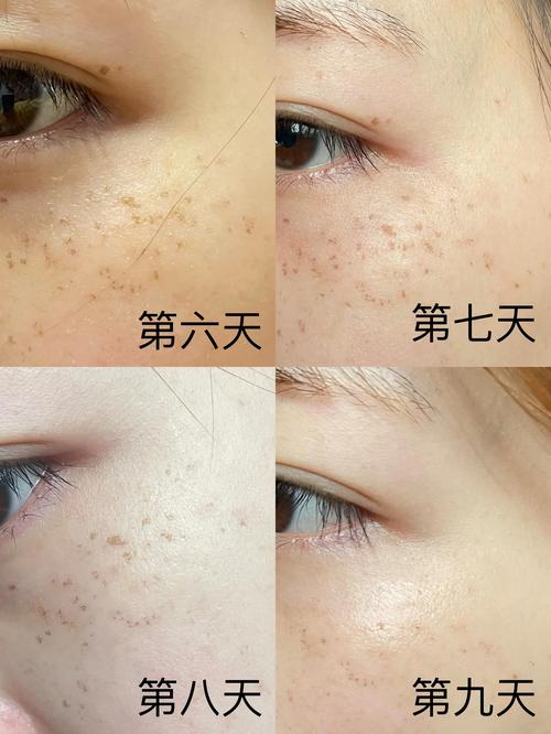 激光祛斑祛痘疤真的有效吗？-图2