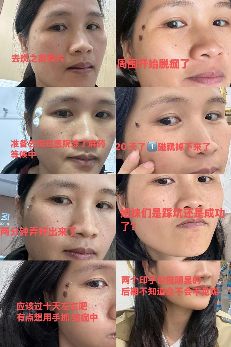 激光祛斑祛痘疤真的有效吗？-图3