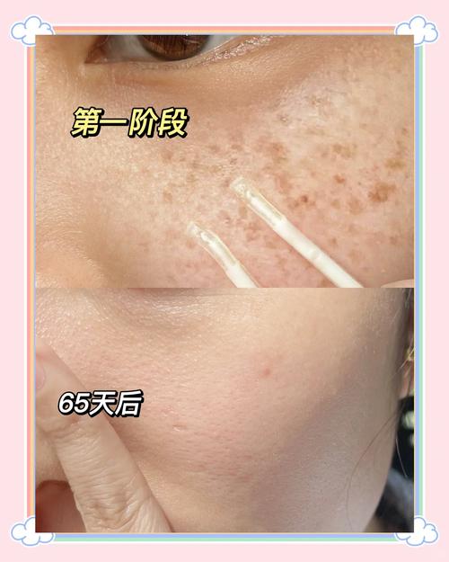 淡盐水祛痘祛斑真有效吗?-图3 淡盐水祛痘祛斑真有效吗?-图3