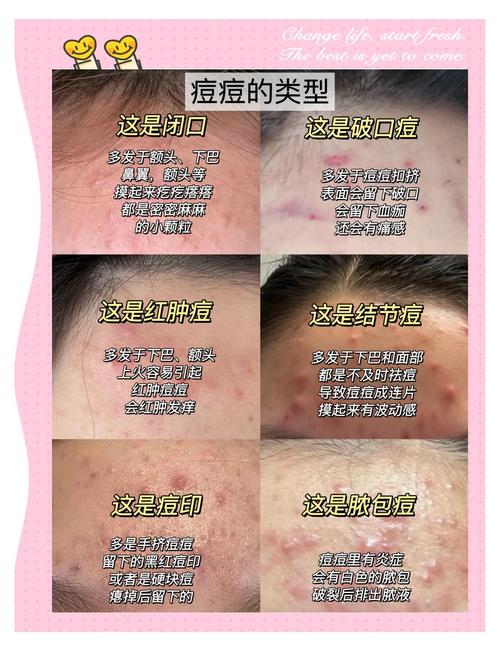 脸上长痘,祛痘到底什么方法最好?-图1 脸上长痘,祛痘到底什么方法最好?-图1