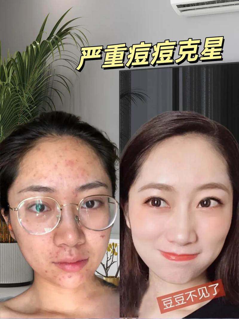 脸上长痘,祛痘到底什么方法最好?-图2 脸上长痘,祛痘到底什么方法最好?-图2