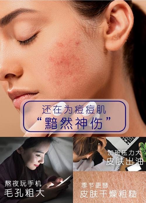 脸上长痘,祛痘到底什么方法最好?-图3 脸上长痘,祛痘到底什么方法最好?-图3