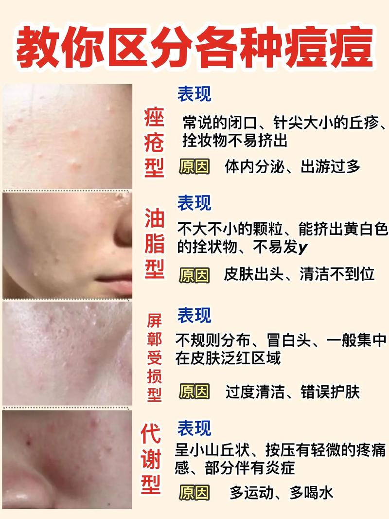 祛痘产品为何还让痘痘反复长？-图2