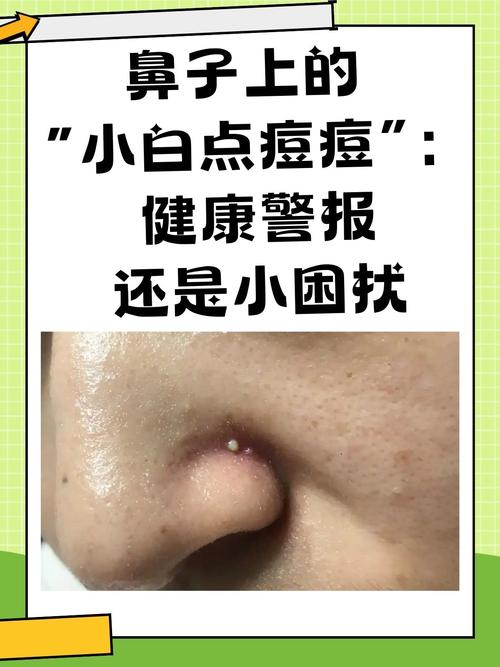 鼻子右侧长痘，如何有效祛除？-图2