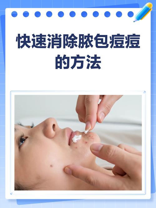 鼻子右侧长痘，如何有效祛除？-图3