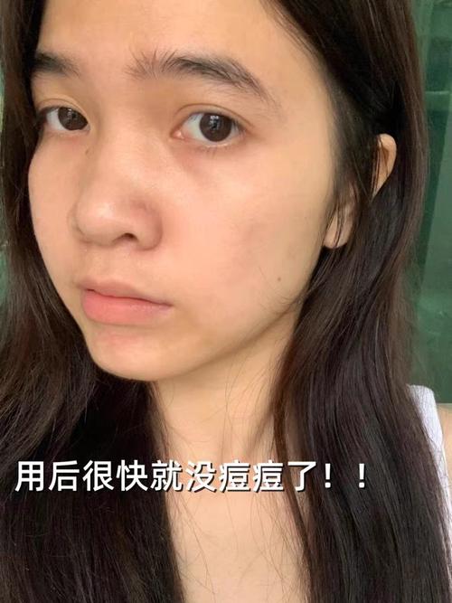 祛痘产品反而致痘,是哪里出问题了?-图1 祛痘产品反而致痘,是哪里出问题了?-图1