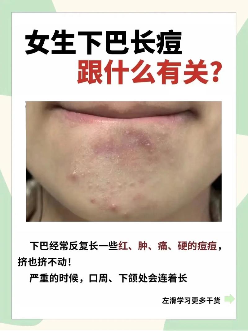 下巴长痘用祛痘老偏方有效吗？-图1
