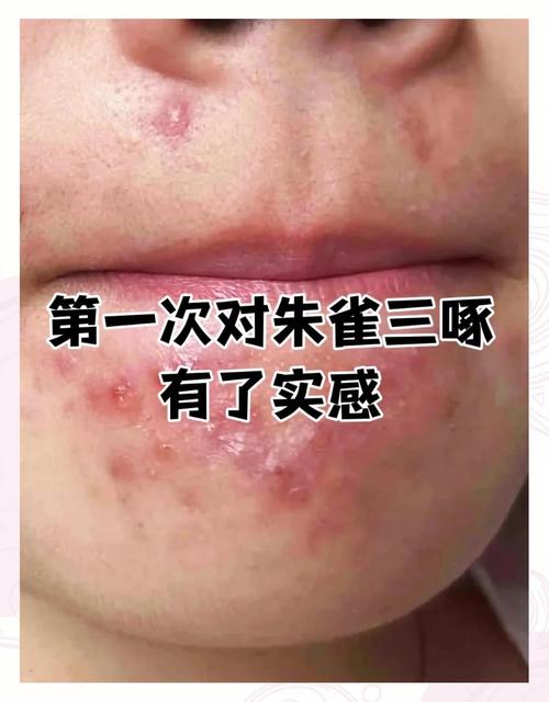 下巴长痘用祛痘老偏方有效吗？-图2