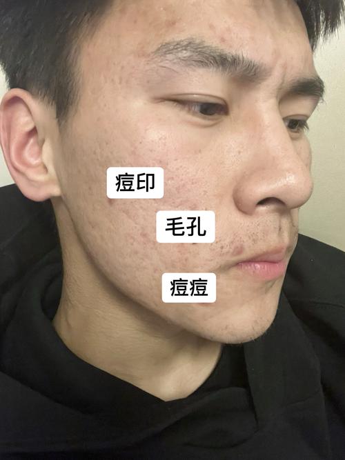 葱白真的能祛痘印吗？-图1