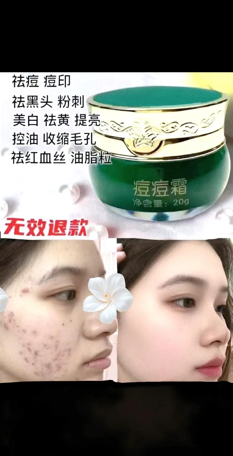 中药祛痘印真的靠谱吗？-图2