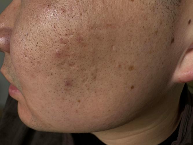 男士痘印痘疤凹洞怎么祛？-图1