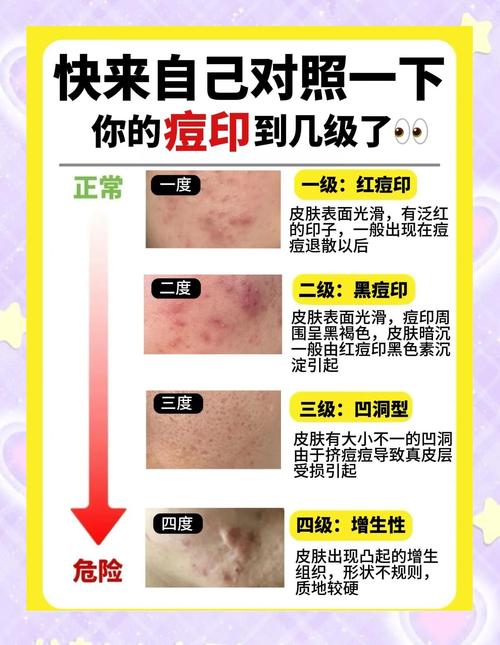 激光祛痘坑祛痘真的安全吗？-图2