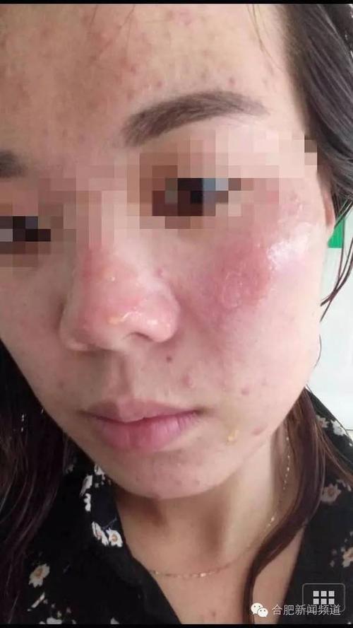 护肤品里加什么会毁容？-图2