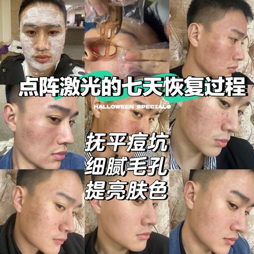 激光祛痘还是祛痘印？效果有何不同？-图2