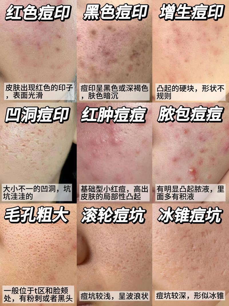 激光祛痘还是祛痘印？效果有何不同？-图3