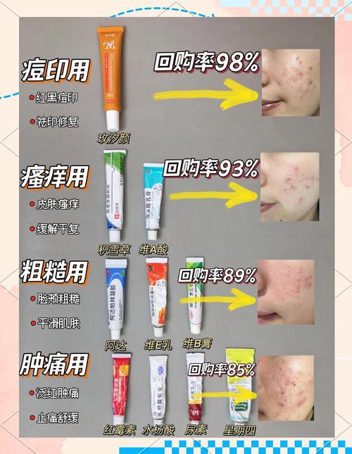 祛痘祛痘印最快方法是什么？-图1