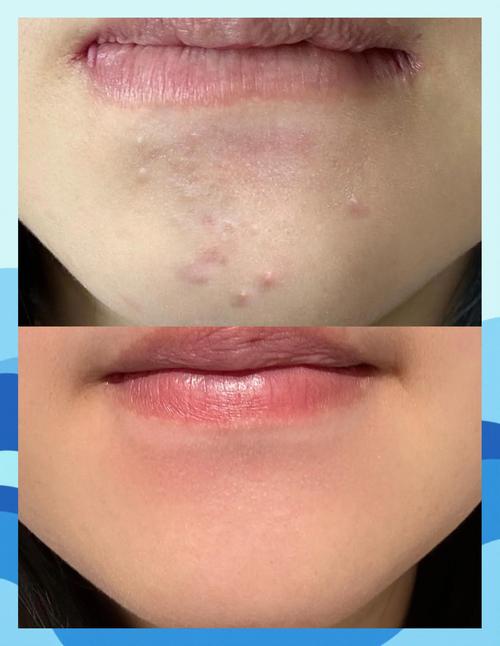 祛痘祛痘印最快方法是什么？-图2