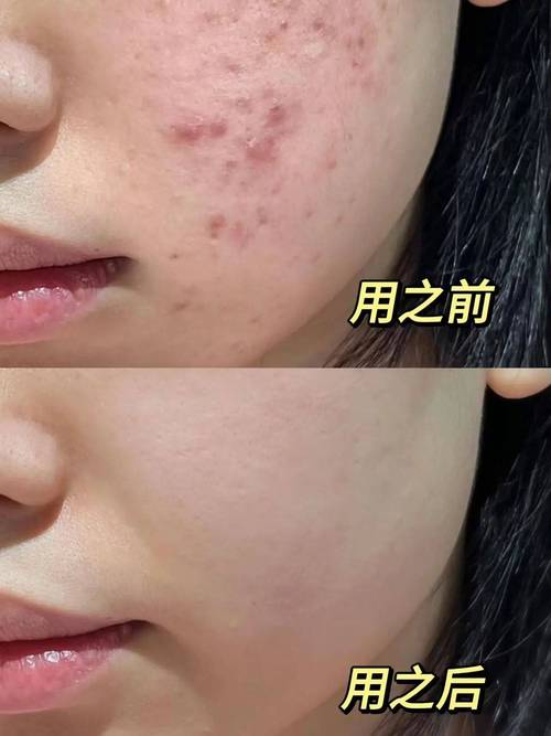 彻底祛痘 祛痘先补水-图2